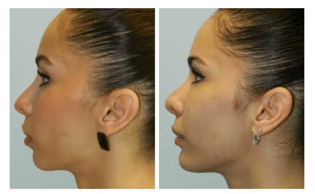 before and after headshot photo from the side of woman after receiving plastic surgery