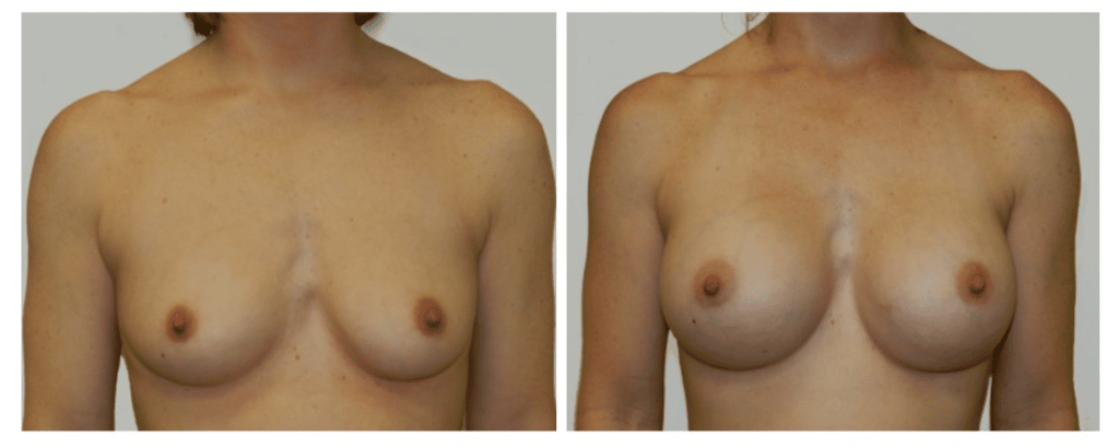 breast augmentation | Dr. David Altamira Houston TX