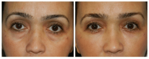 Eyelid Surgery | Dr. David Altamira Houston TX