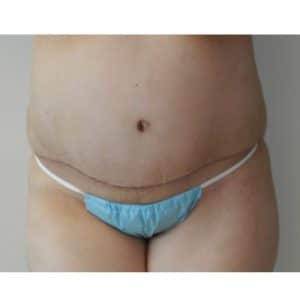 Tummy Tuck Before & After Photos Houston | Abdominoplasty Sugar Land