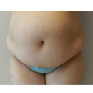 Tummy Tuck Before & After Photos Houston | Abdominoplasty Sugar Land Tummy Tuck Before & After Photos Houston | Abdominoplasty Sugar Land
