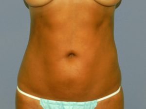 woman’s stomach before and after liposuction, stomach flatter after procedure