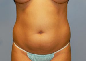 woman’s bare stomach before liposuction