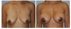 bare female chest before and after breast lift
