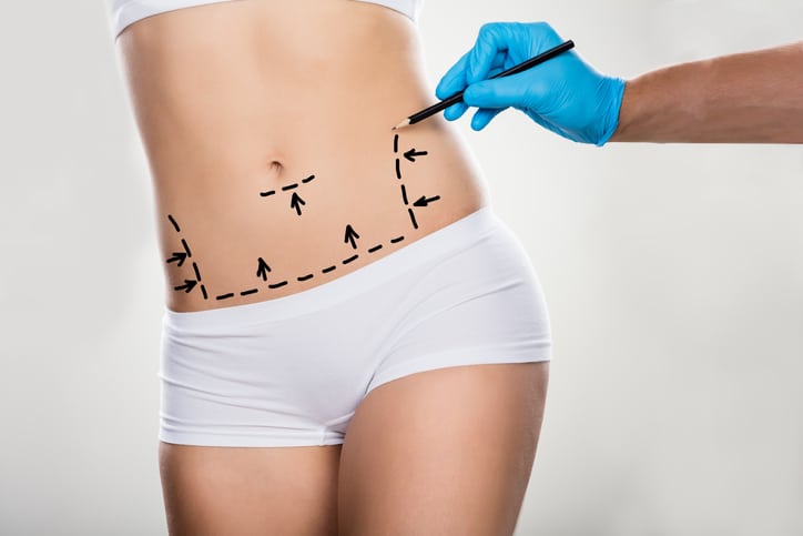 close up of woman's midsection in underwear as doctor draws plastic surgery guidance marks