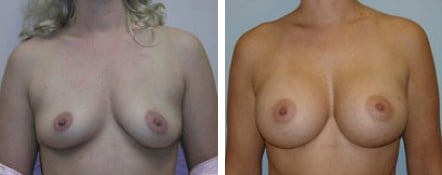 Breast Augmentation Before & After Houston TX