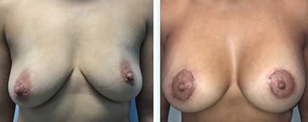 Breast Augmentation Before & After Houston TX