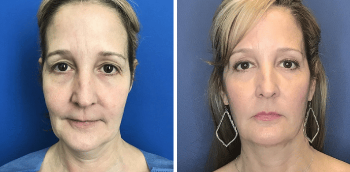 FaceTite David Altamira,MD - Case 1