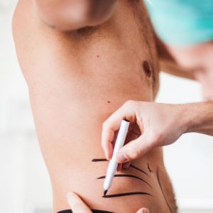drawing correction lines on man's stomach