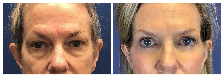 Upper and Lower Blepharoplasty | Dr. David Altamira Houston TX