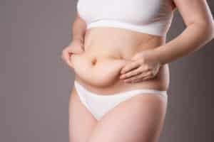 Tummy tuck 