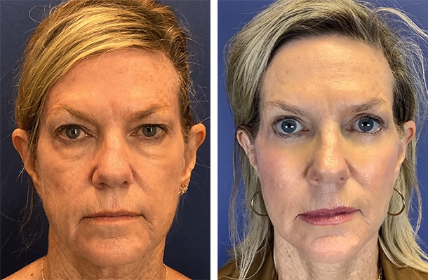 Before & After Image of Facelift West Houston TX