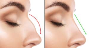 Close-up comparison of a woman's profile, before and after rhinoplasty