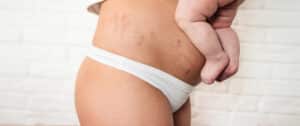 Close up of woman's lower body after childbirth as she considers vaginal rejuvenation in Houston