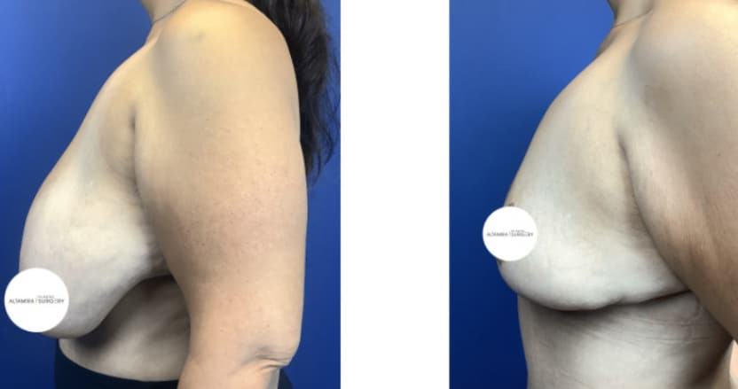 Mommy Makeover breast Before & After Houston TX