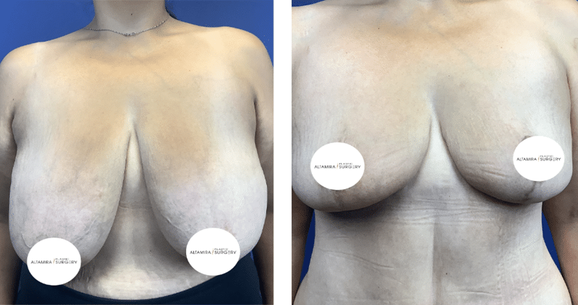 Mommy Makeover breast Before & After Houston TX