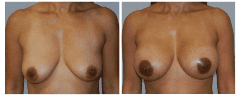 breast-lift-aug-768x315