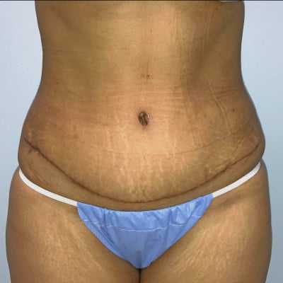After photo showing the same woman with a thin stomach and temporary scars from plastic surgery